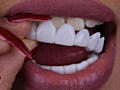 Съемные виниры для зубов Snap-On Smile. Накладные зубы