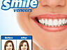 Виниры на зубы Perfect Smile Veneers