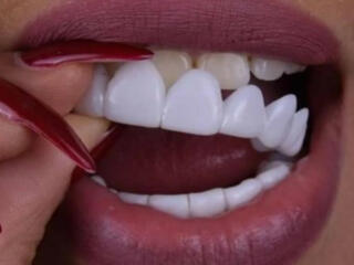 Съемные виниры для зубов Snap-On Smile. Накладные зубы