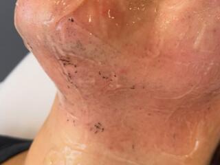 Epilare cu laser bărbați și femei pentru toate zonele