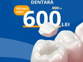 Ofertă specială 600 lei în loc de 900 lei Obturație fotopolimerizabila