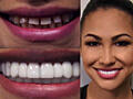 Съемные виниры для зубов Snap-On Smile. Подарите себе идеальную улыбку